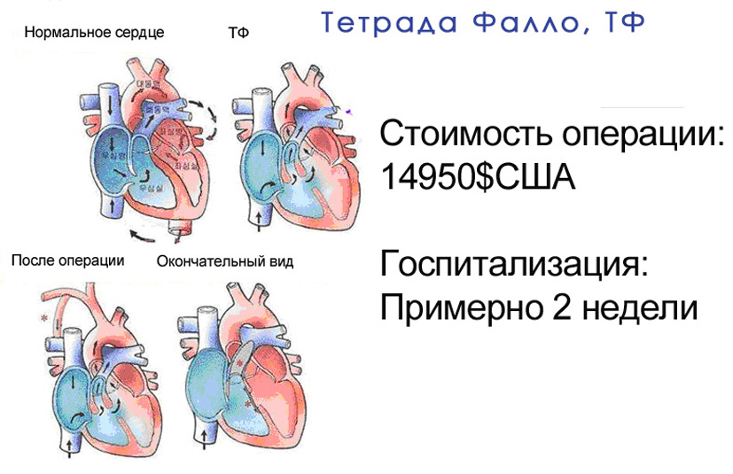 Тетрада фалло лечение